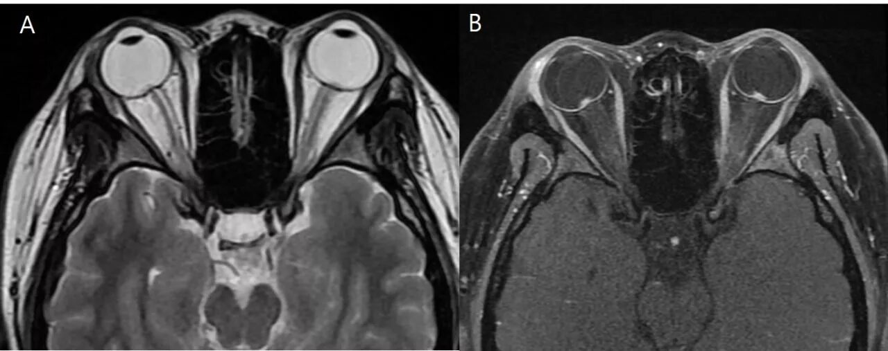 Мрт глазного нерва. Экзофтальм на кт. Ретробульбарный неврит мрт. Менингиома зрительного нерва мрт. Неврит зрительного нерва мрт.