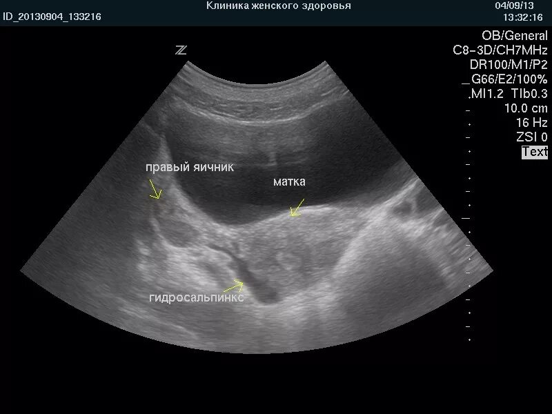 УЗИ картина гидросальпинкса. УЗИ снимки гидросальпинксов. Гидросальпинкс яичника. Гидросальпинкс лечение операции