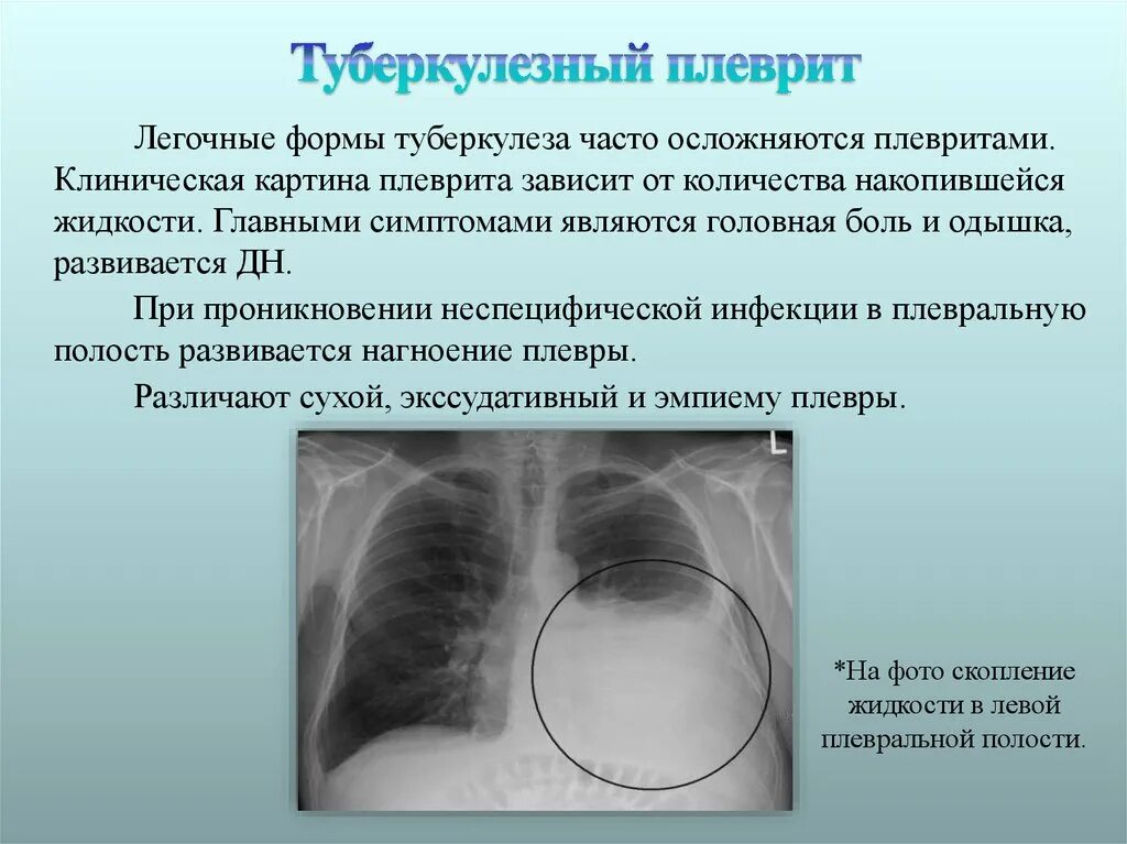 Плевральные осложнения. Экссудативный плеврит при туберкулезе рентген. Туберкулезный экссудативный плеврит. Экссудативный плеврит выпот. Туберкулёзный плеврит рентген диагноз.