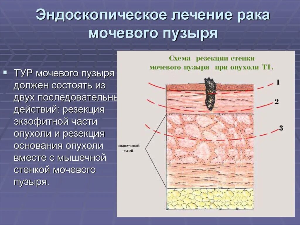 После операции тур мочевого пузыря. Тур опухоли мочевого пузыря. Тур при опухоли мочевого пузыря схема. Тур мочевого пузыря ход операции.