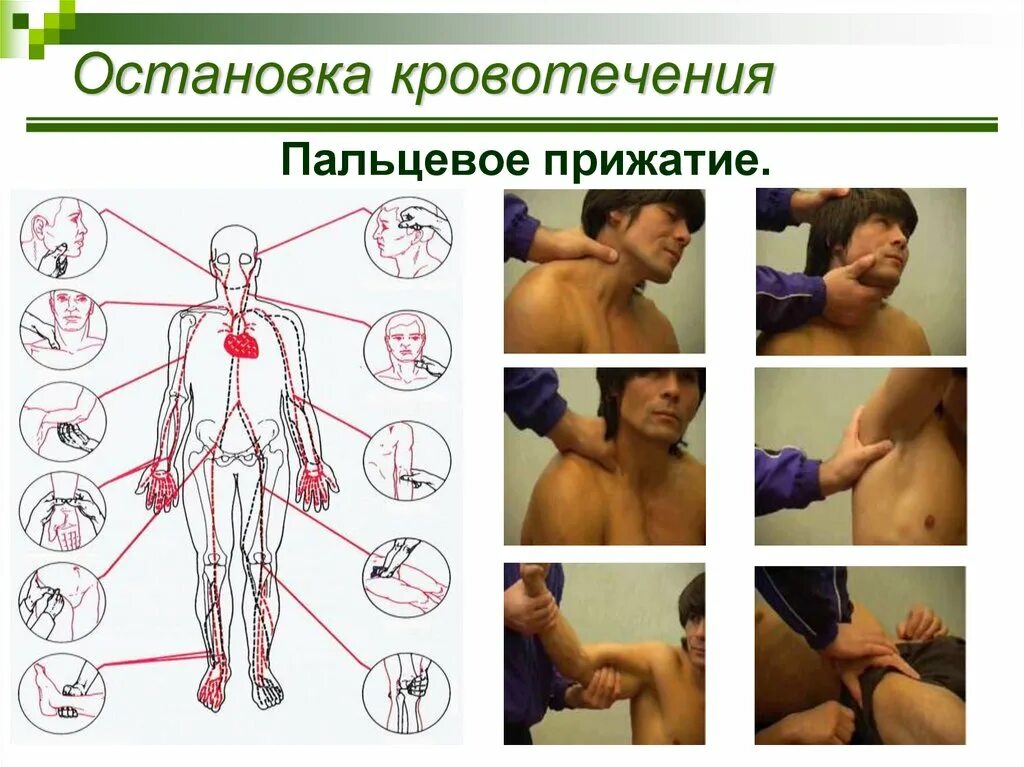 Остановка кровотечения прижатием