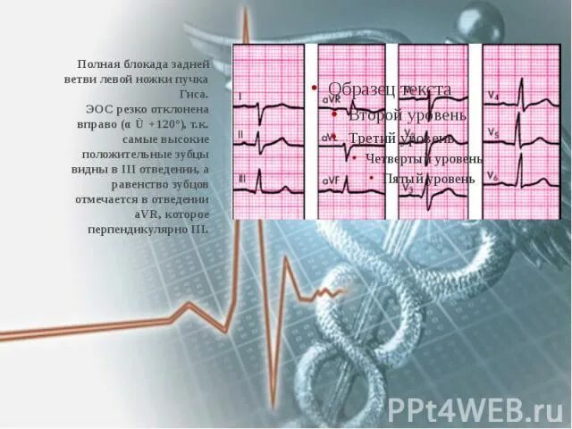 Блокада левой передней ветви п. Блокада передневерхнего разветвления левой ножки пучка гиса. Блокада лнпг на экг. Блокада левой передней ножки пучка гиса на экг. Экг при блокаде передней ветви левой ножки пучка гиса.