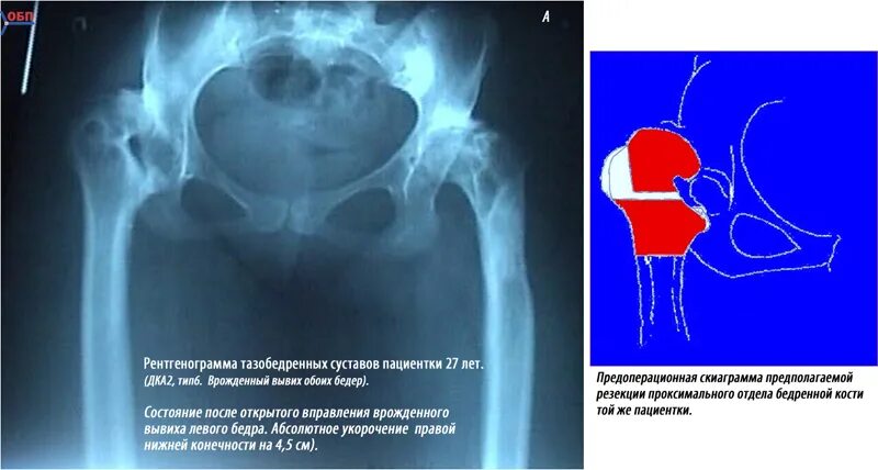 Коксартроз тазобедренного сустава рентген. Коксартроз тазобедренного сустава мрт. Вывих тазобедренного сустава рентген. Рентген снимок тазобедренного сустава коксартроз.