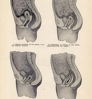 Female Anatomy Womb Displacement Chart 1906 Edwardian Era image 0 