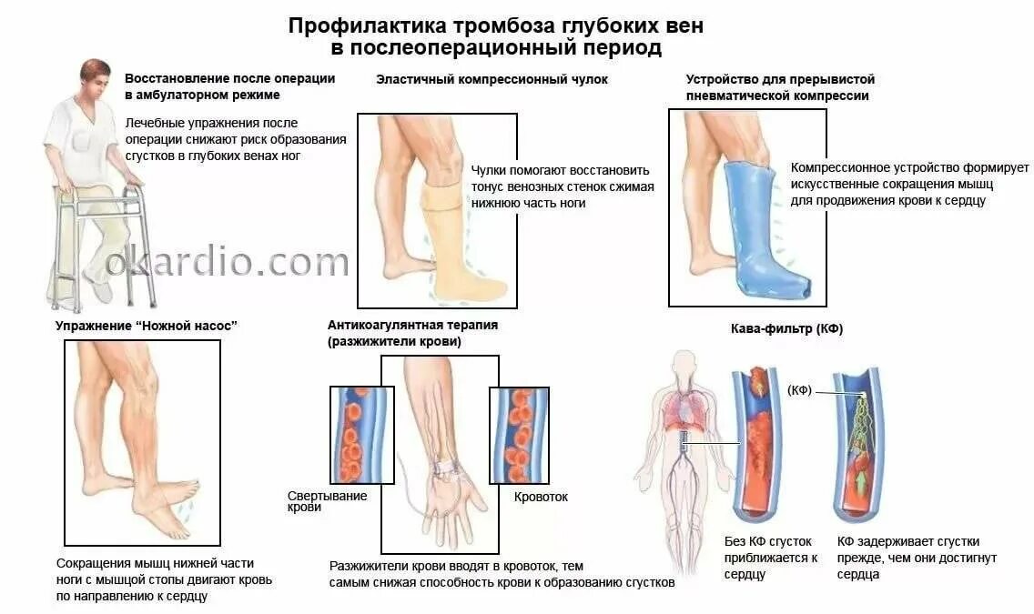 Сильно болит нога после операции. Тромбоз глубоких вен нижних конечностей схема. Острый тромбофлебит нижних конечностей. Тромбофлебит нижних конечностей глубоких вен препараты. Профилактика тромбоза глубоких вен после флебэктомии.