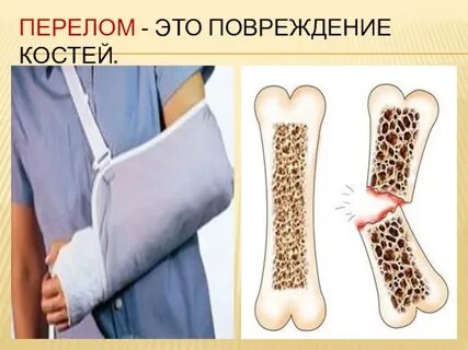 Сломанные кости человека