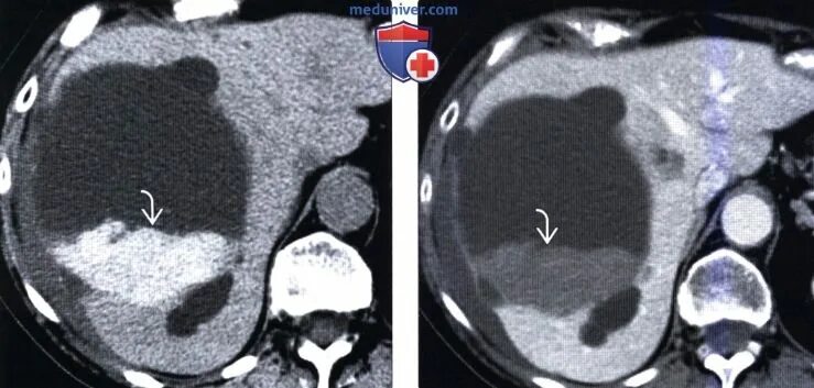 Киста печени мрт. Эхинококковая киста печени кт. Обызвествленная киста печени кт. Непаразитарные кисты печени кт. Паразитарная киста мрт.