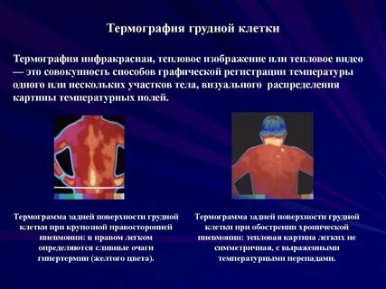 Потливость грудины