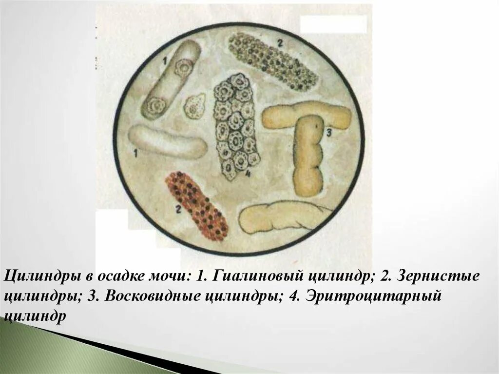 Повышены цилиндры в моче. Гиалиновые цилиндры микроскопия. Цилиндры в осадке мочи. Зернистые цилиндры в моче. Гиалиновые и зернистые цилиндры в моче.