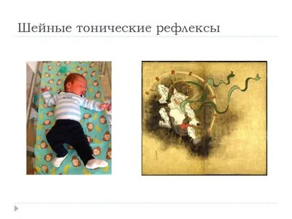 Шейно тонический рефлекс