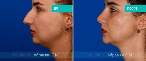 Абрамян пластический