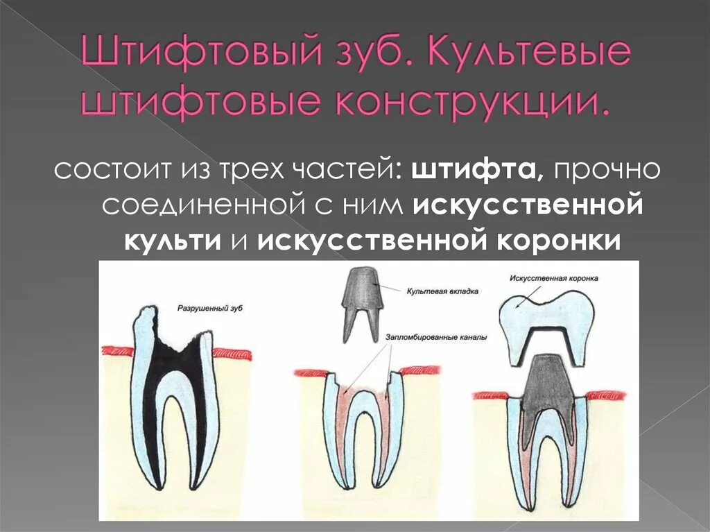 Какую функцию выполняет коронка зуба. Штифтовые конструкции. Культевые штифтовые конструкции. Культевая Штифтовая конструкция. Конструкции штифтовых зубов.