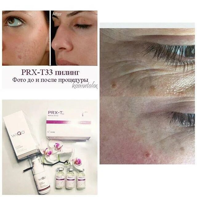 Пилинг прх т33. Prx-t33. пилинги prx-t33.