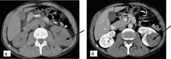 Опухоль паренхимы почки кт. Почечно клеточная карцинома кт. Кт опухоль почек с контрастированием кт. На кт видно опухоль