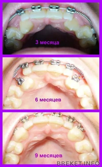 Брекеты проволока и дуга. Вылетела дуга из последнего брекета. Выскочила дуга из брекета. Реверсивная дуга для брекетов. Прямоугольная дуга для брекетов.