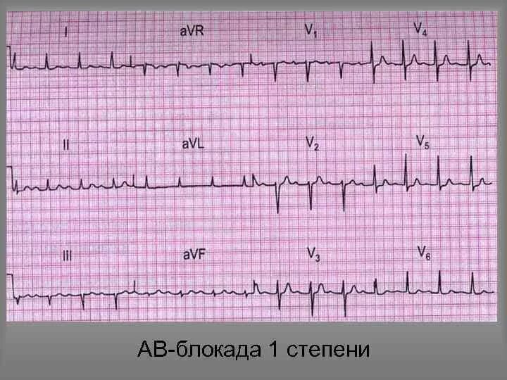 АВ блок 1 степени на ЭКГ. АВ блокада 1 степени на ЭКГ. Атриовентрикулярная блокада 1 степени на ЭКГ. ЭКГ при АВ блокаде 1 степени.