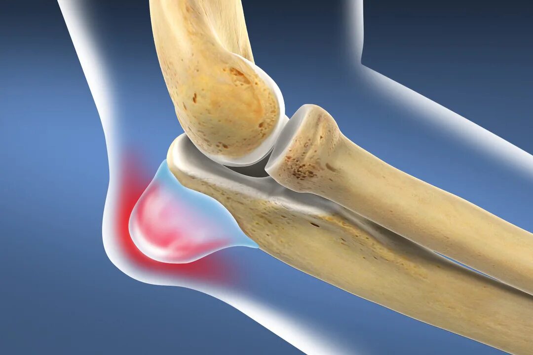 Воспаленный бурсит локтевого сустава. Бурс ИТ лок евого сустава. Околосуставные сумки локтевого сустава. Бурсит локтевого отростка. Гнойные заболевания суставов