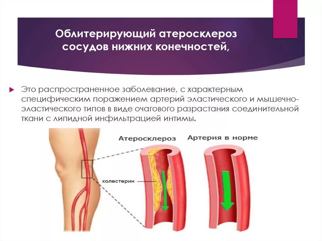 Сосуды при ампутации. Клинические проявления атеросклероза сосудов нижних конечностей. Клиническая картина атеросклероза сосудов нижних конечностей. Облитерирующие заболевания сосудов конечностей. Клинические симптомы атеросклероза сосудов нижних конечностей.