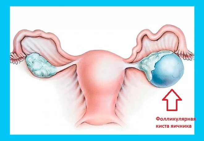 Функционирующий яичник. Нагноение кисты яичника. Фолликулярная киста яичника 55мм. Фолликулярная киста яичника на УЗИ. Фолликулярная киста левого яичника.