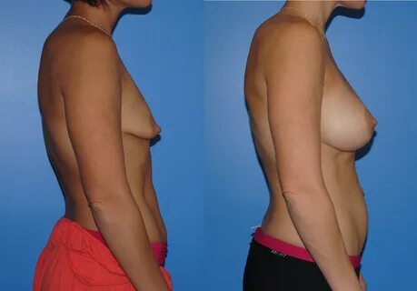 Tuberous breast deformity is best corrected with a breast augmentation proc...