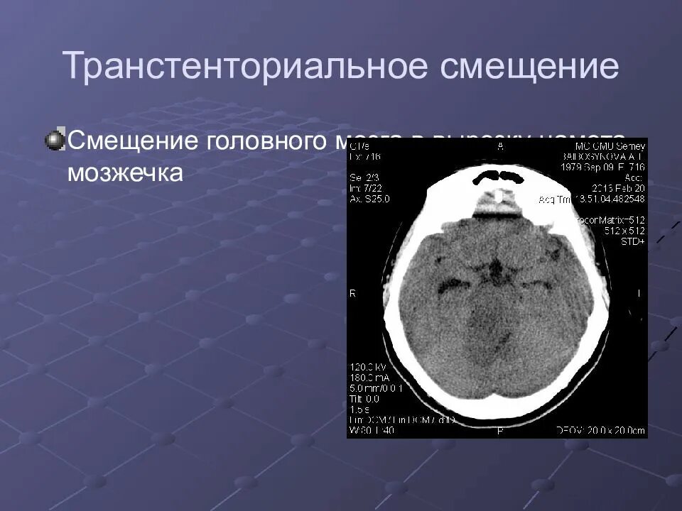 Травматический отек мозга. Дислокация головного мозга на кт. Вклинение головного мозга кт. Аксиальная дислокация на кт. Аксиальная дислокация головного мозга.