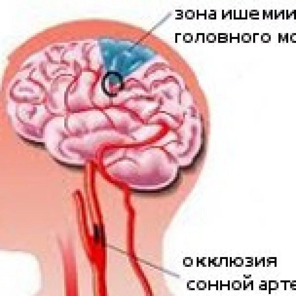 Закупорка головных сосудов. Окклюзия сосудов головного мозга. Окклюзия церебральных артерий. Окклюзия сонной артерии.