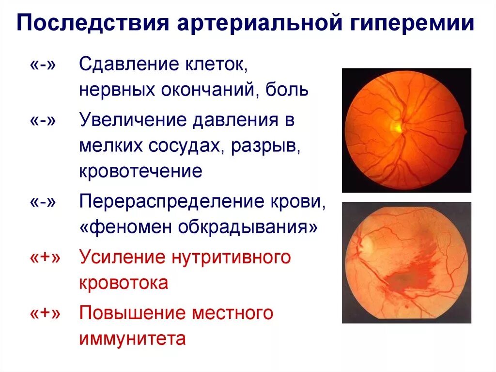 Артериальная гиперемия воспаление. Последствия артериальной гиперемии. Осложнения артериальной гиперемии. Физиологическая артериальная гиперемия. Патологическая артериальная гиперемия.