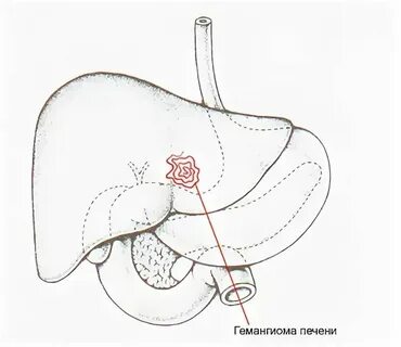 Болит печень гемангиома