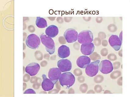 Острый лейкоз клеточного типа