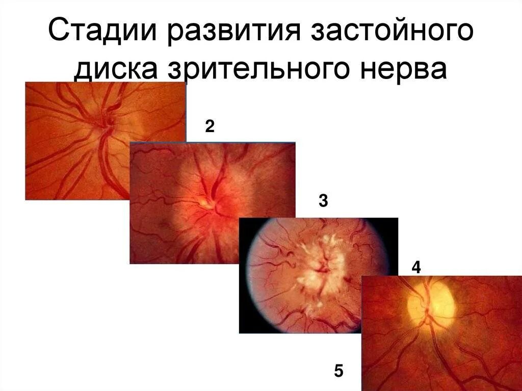 Нейропатия глаза. Застояный диска зрительного нерва. Отек диска зрительного нерва стадии. Стадии развития застойного диска зрительного нерва. Начальный застойный диск зрительного нерва.