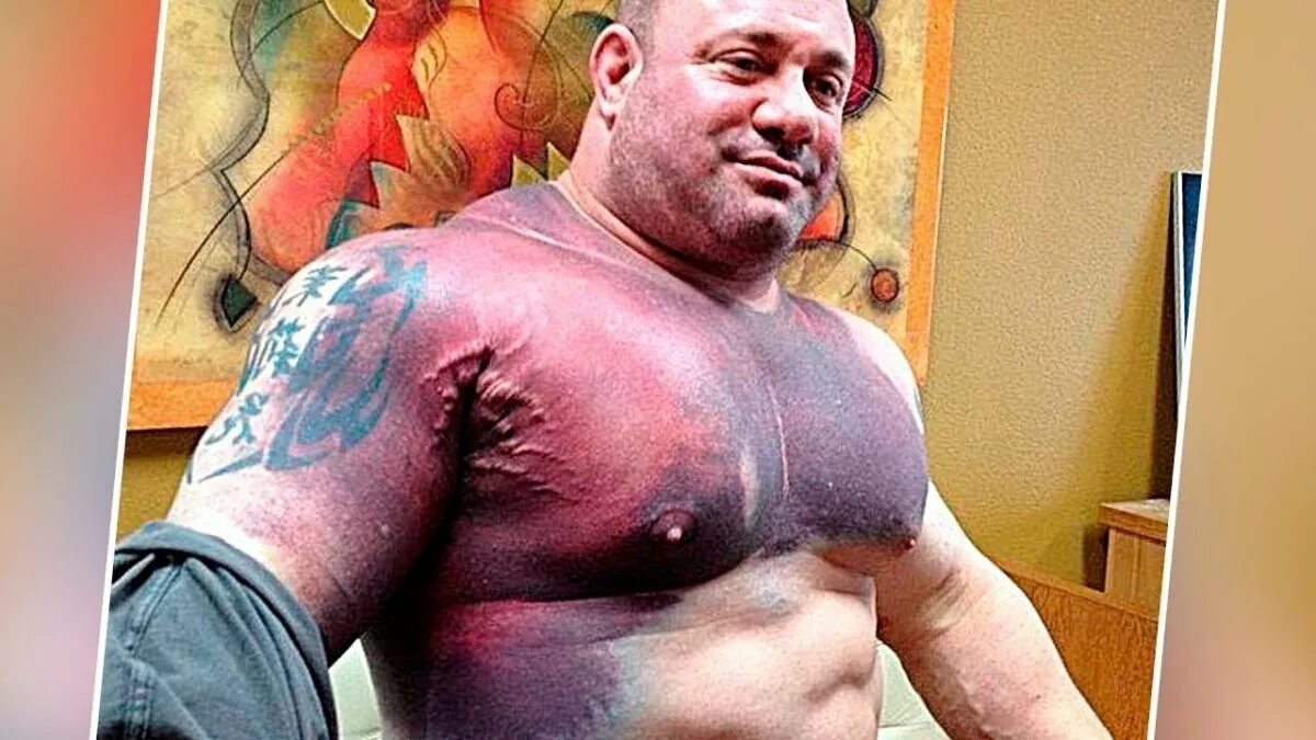 Отрыв дистального сухожилия двуглавой мышцы плеча. Надрыв сухожилия бицепса. Растяжение сухожилия бицепса. Бицепс после разрыва. Разрыв сухожилия двуглавой мышцы операция.