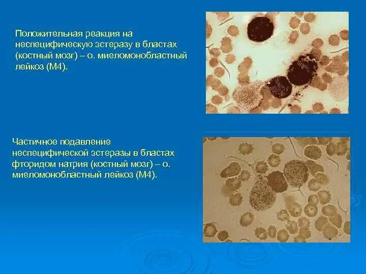 Резко положительная реакция. Неспецифическая эстераза. Реакция на неспецифическую эстеразу. Неспецифическая эстераза цитохимия. Реакция на неспецифическую эстеразу при лейкозах.