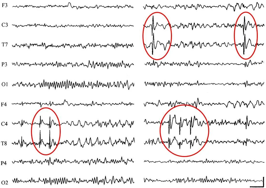 Эпи ээг. Эпилептиформные паттерны на ЭЭГ. ЭЭГ головного мозга больного эпилепсией. ЭЭГ эпилепсия пик-волна. Эпилептиформная активность на ЭЭГ.