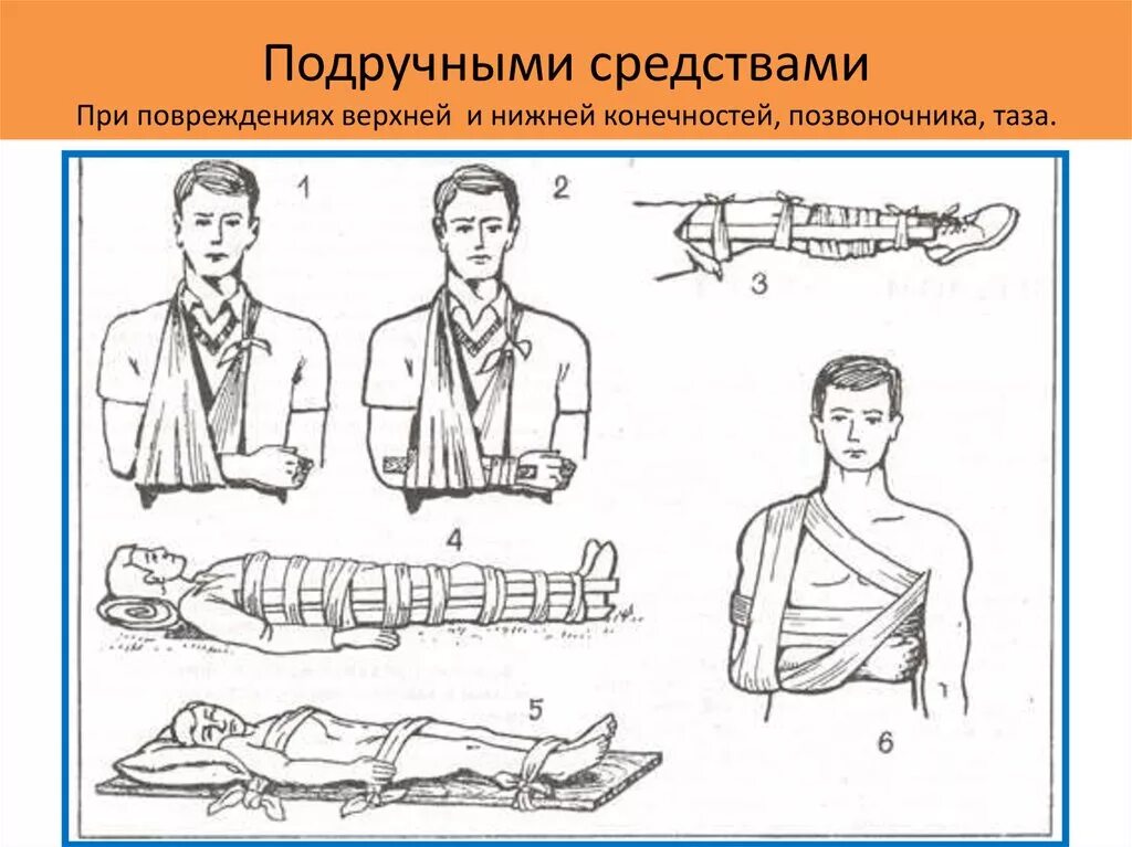 1 помощь при переломе верхней конечности. Иммобилизация конечности при переломе. Оказание первой помощи при переломах. Иммобилизация переломов подручными средствами. Фиксация конечностей при переломах.