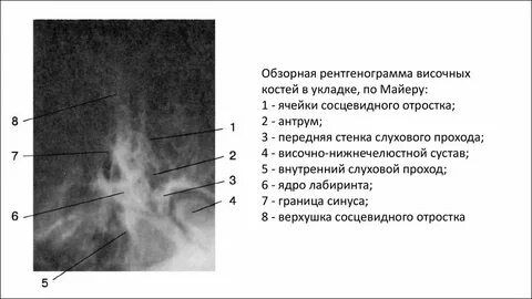 Рентген височных