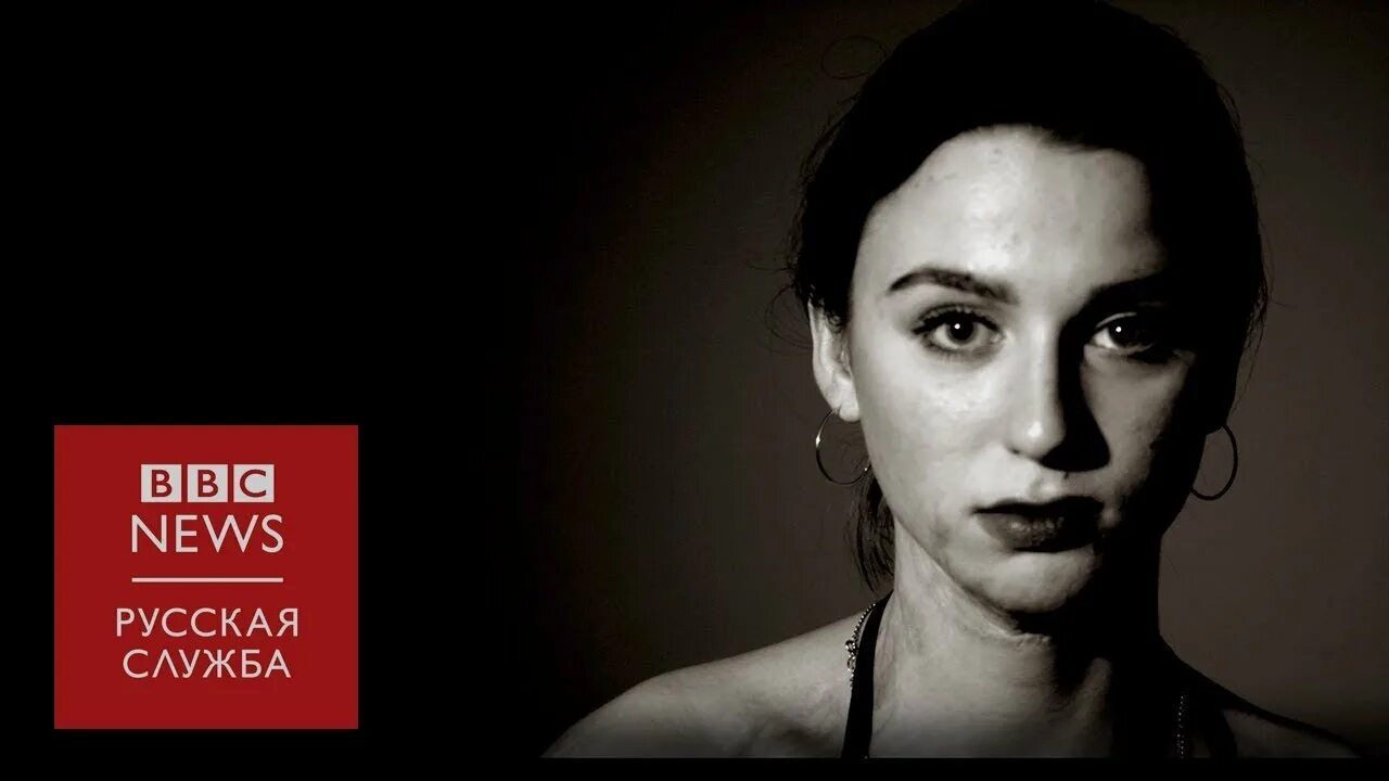 Светой уголек. Света уголек — модель с ожогами 45 % тела. Света уголек — модель с ожогами 45 % тела. Светой уголек. Светой уголек.