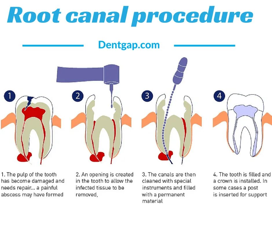 Радикулярная киста зуба. Зубы кита. Лечение кисты зуба. Лечение кисты зуба. Кистозная гранулема зуба.