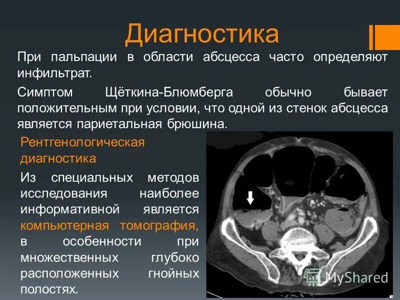 Инфильтрат брюшной полости. Абсцессы брюшной полости диагностика. Инфильтрат брюшной полости на кт. Абсцесс брюшной полости на кт. Наличие гноя в брюшной полости