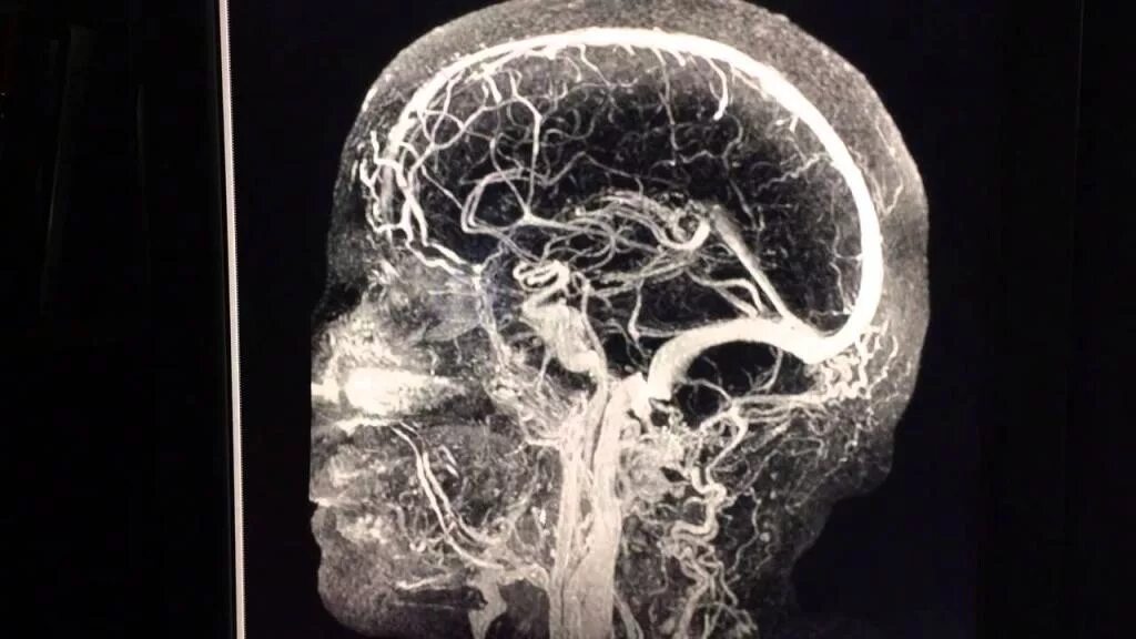 Венография головного мозга. МРА (магнитно-резонансная ангиография). МР-ангиография сосудов головного мозга. Мрт головного мозга с ангиографией. Времяпролетная ангиография.