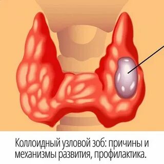 Многоузловой зоб 2 степени