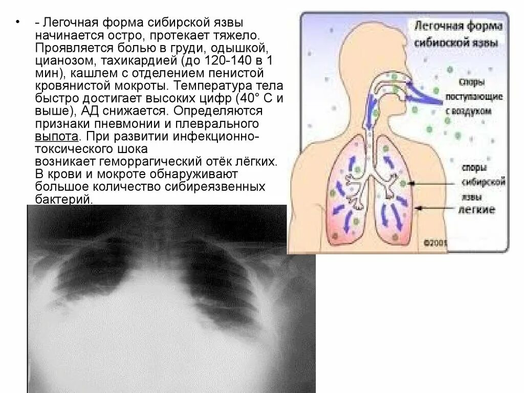 Легочная язва. Легочная форма сибирской язвы характеризуется. Сибирская язва легочная форма симптомы. Сибирская язва клиника легочная форма. Мокрота при легочной форме сибирской язвы.