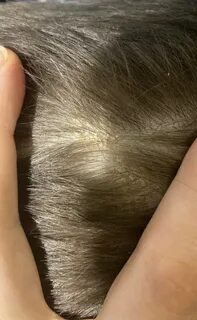 Корки перхоти на голове