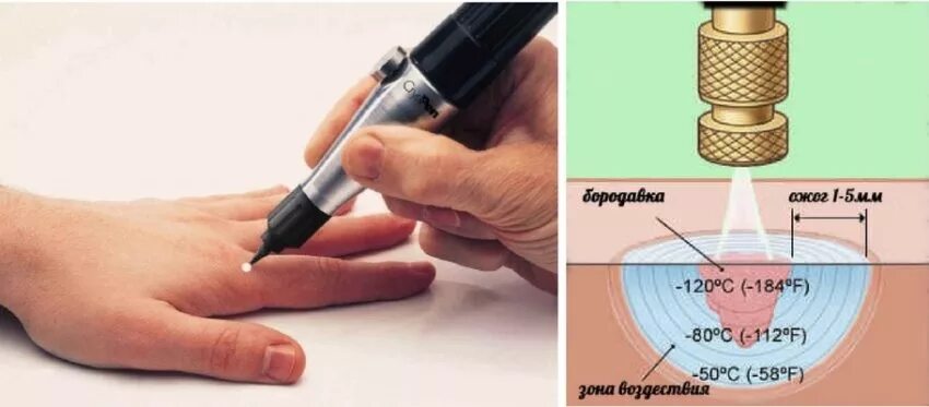 Выжигание азотом шипигк. Выжигать азотом. Криодеструкция шипицы. Выжигать азотом. Выжигать азотом.