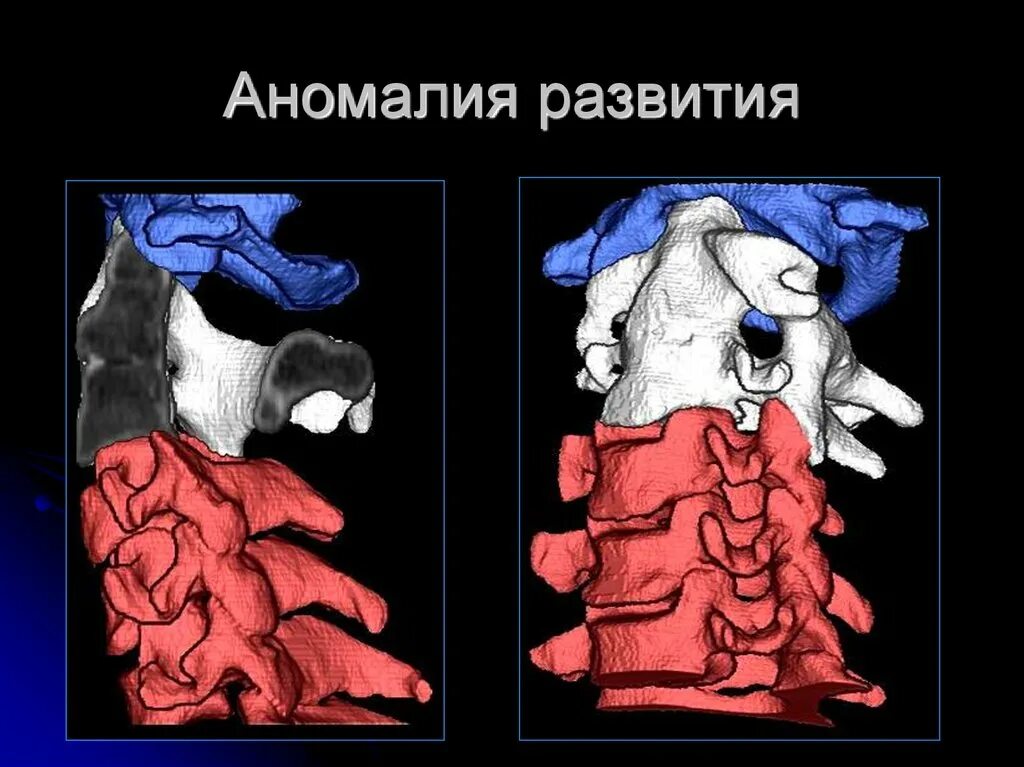 Аномалии развития позвоночника. Аномалия позвоночника Кимберли. Врожденная аномалия развития позвоночника. Врожденная аномалия развития позвонков рентген. Множественные пороки развития позвоночника.