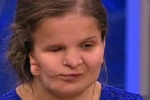 Синдром гольденхара