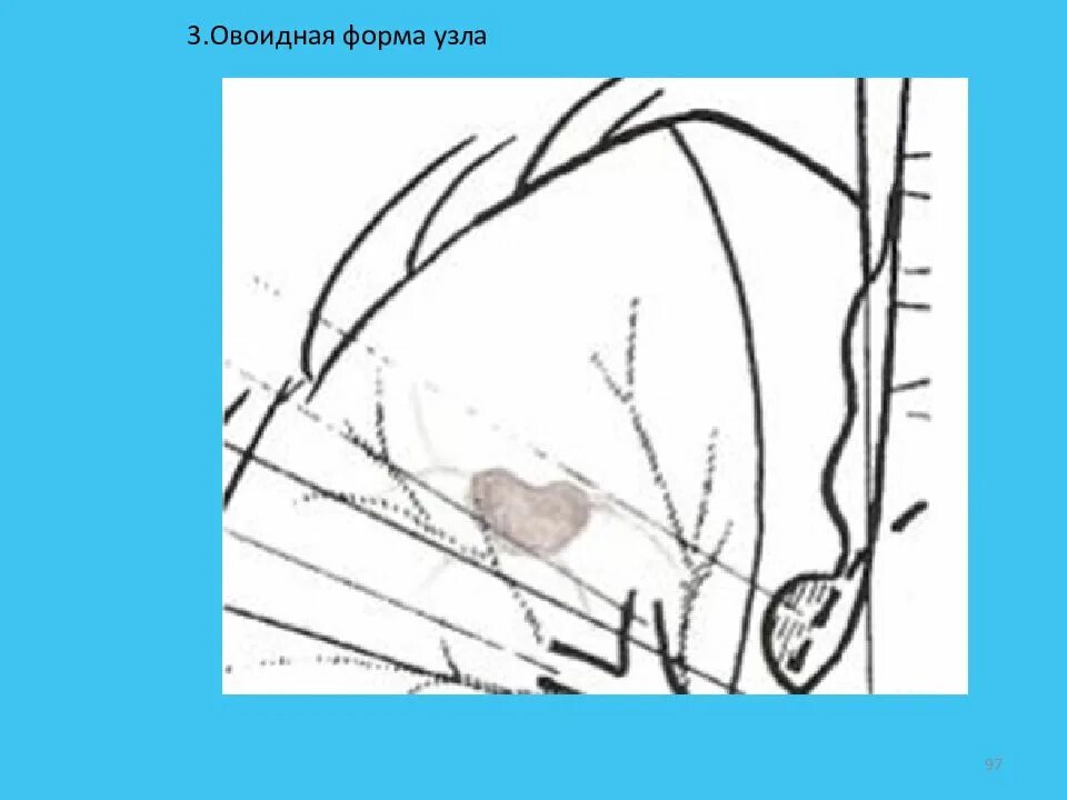 Овоидной формы что это