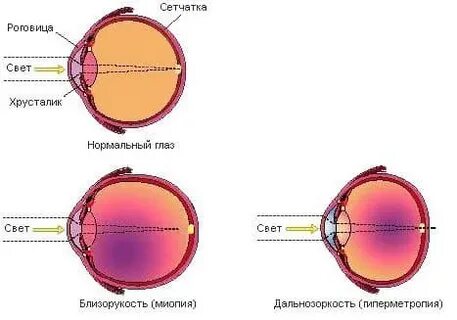 Глаз при близорукости и дальнозоркости