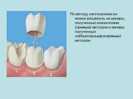 Прямой метод изготовления коронок