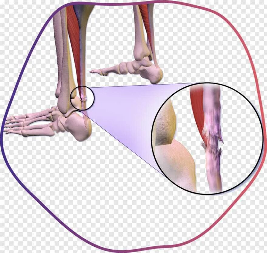 Танзенит ахилового сухожилия. Растяжение ахиллова сухожилия (тендинит). Тендинопатия ахиллова сухожилия. Теедит ахиллова сухожилия. Ахиллово сухожилие разрыв ахиллова сухожилия
