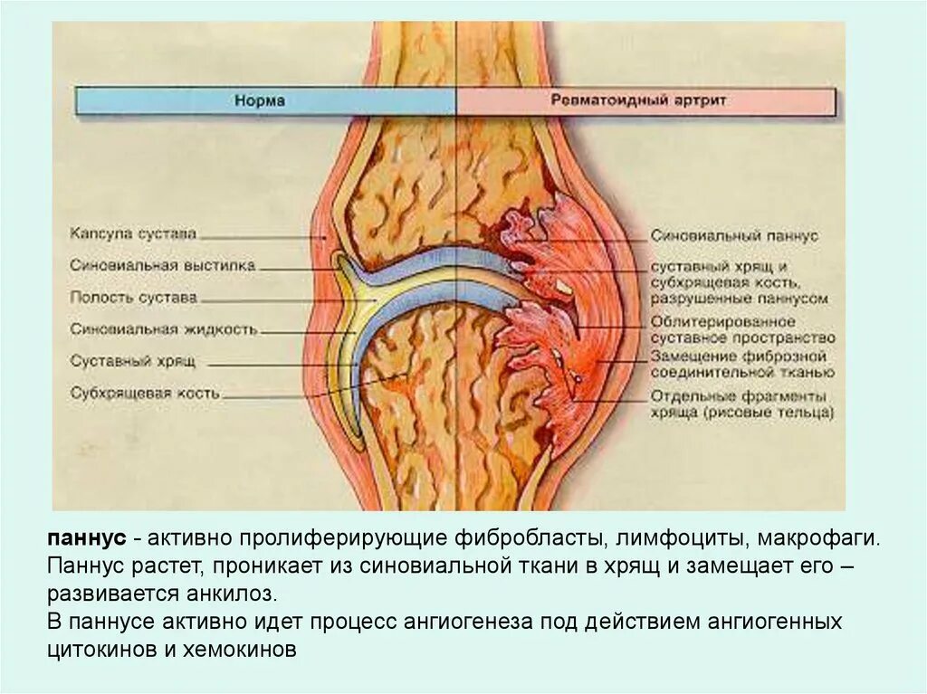 Кишечник артрит. Паннус ревматоидный артрит. Синовиальная оболочка паннус. Ревматоидный артрит суставной симптомы. Паннус коленного сустава.